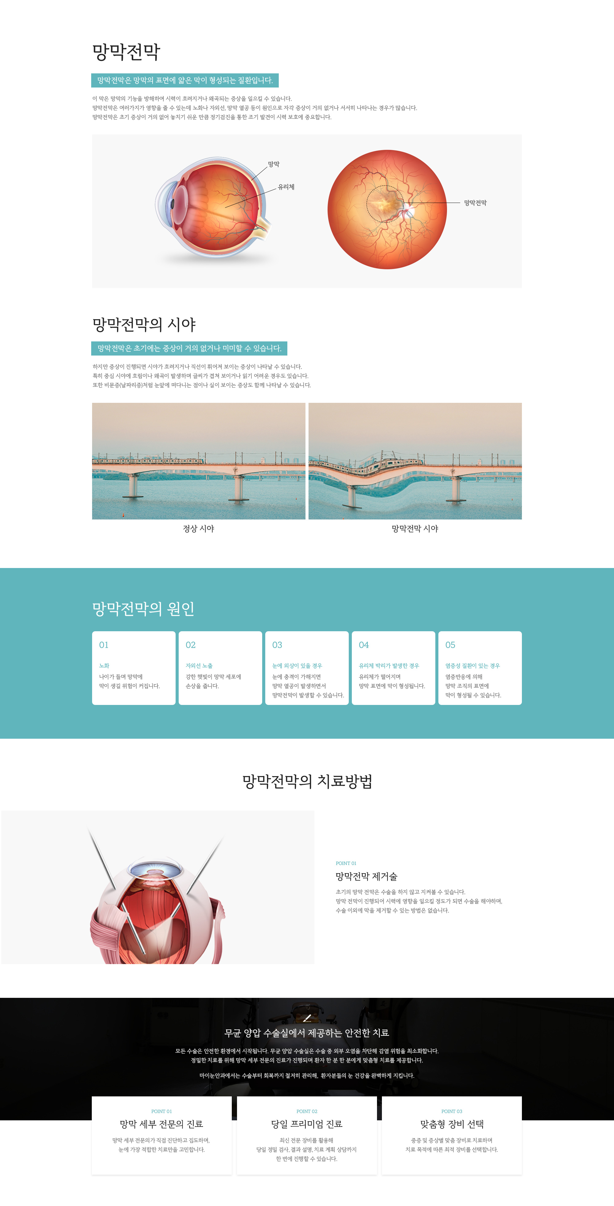 망막전막